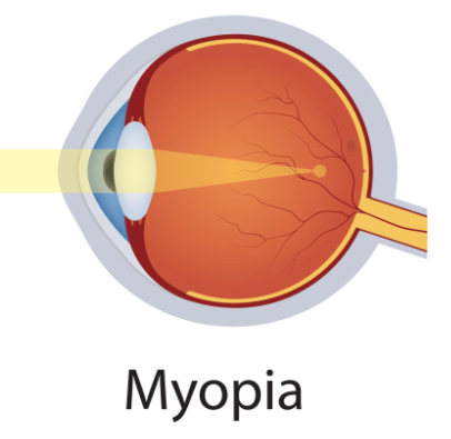 Myopia